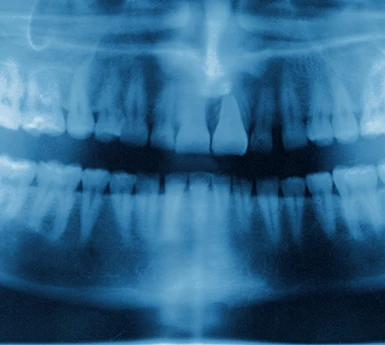 Drill Dental Bar package dental implants
