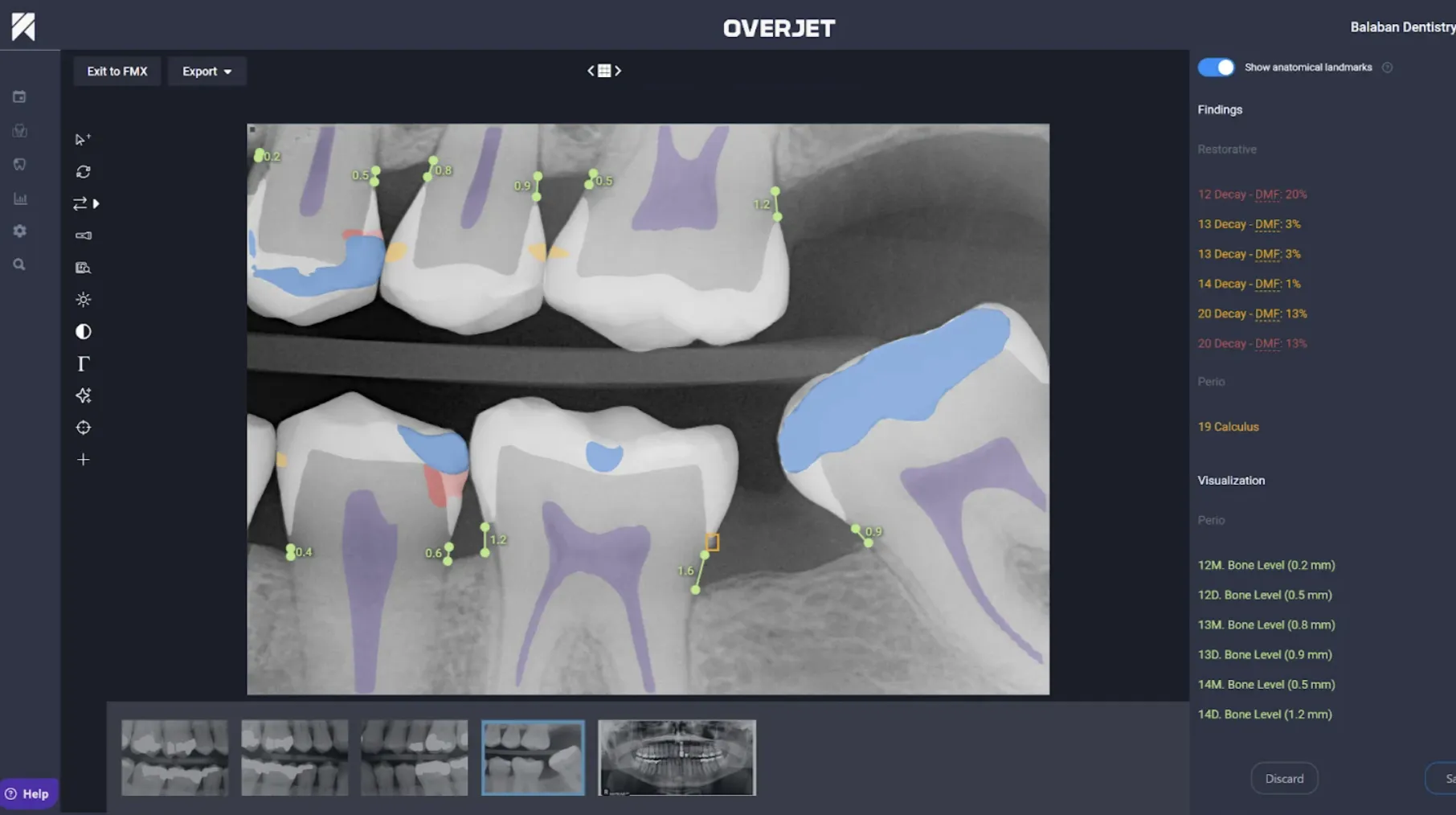 Overjet example showing color-coded highlights on a dental X-ray